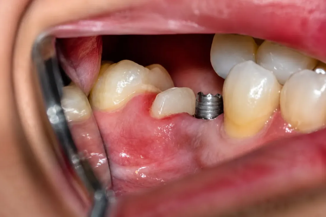 Cas 4 — Étape clinique