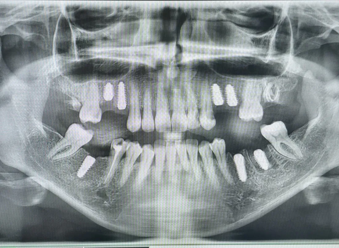 Cas 8 — Radiographie après