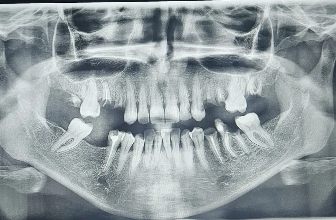 Cas 8 — Radiographie avant